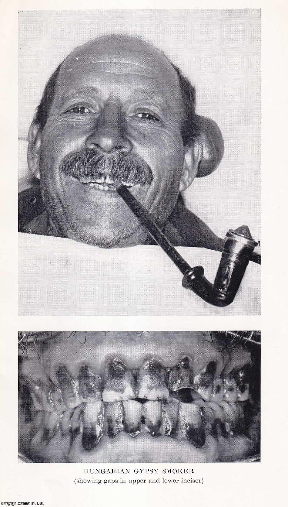 Dr. K. Balogh and Dr. G. Huszar - The Teeth of Hungarian Gypsies. An uncommon original article from the Journal of the Gypsy Lore Society, 1962.
